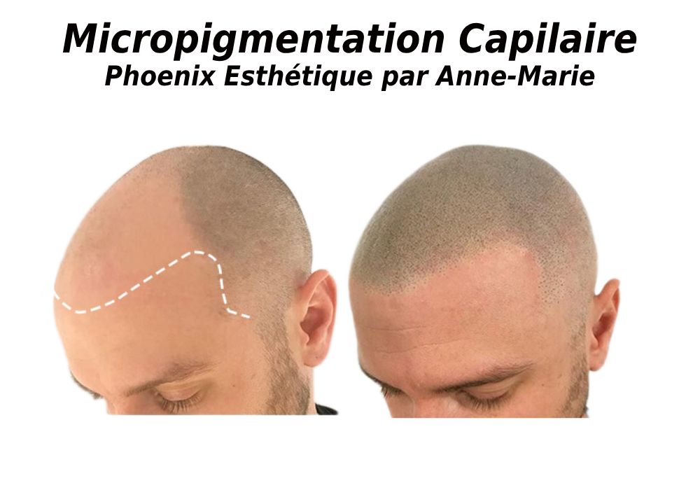 Traitement cellulite à Montréal chez Phoenix Esthétique par Anne-Marie