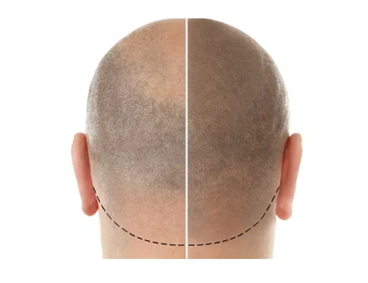 Rabais exclusif sur la micropigmentation capillaire